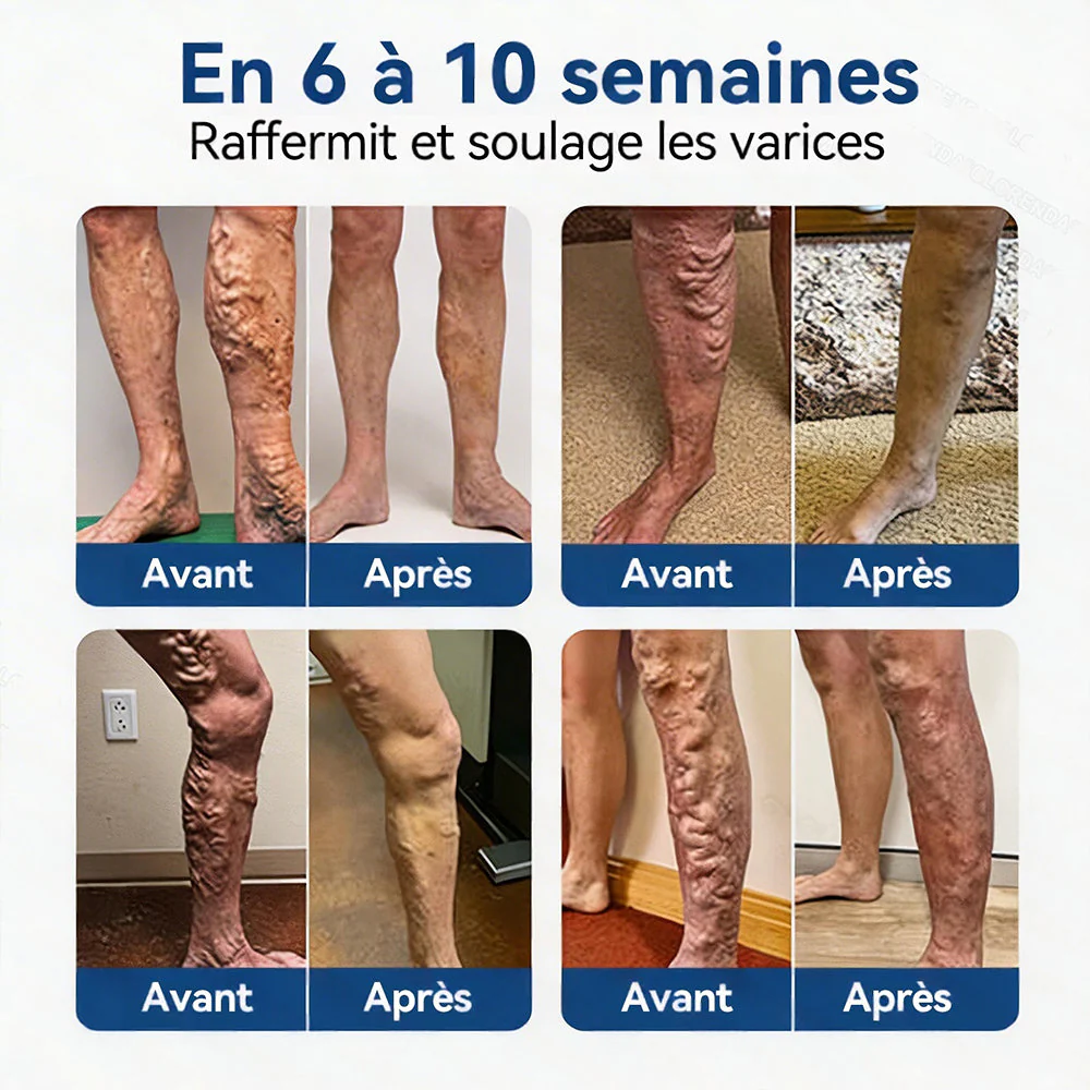 𝐏𝐮𝐫𝐞𝐥𝐨𝐫𝐚® 𝐏𝐚𝐭𝐜𝐡 𝐌𝐢𝐜𝐫𝐨-𝐀𝐢𝐠𝐮𝐢𝐥𝐥𝐞𝐬 𝐂𝐨𝐧𝐭𝐨𝐮𝐫 𝐝𝐞𝐬 𝐕𝐞𝐢𝐧𝐞𝐬 𝐚𝐮 𝐃𝐢𝐨𝐬𝐦𝐢𝐧𝐞 & 𝐀𝐞𝐬𝐜𝐢𝐧𝐞 🌿𝐑é𝐬𝐮𝐥𝐭𝐚𝐭𝐬 𝐯𝐢𝐬𝐢𝐛𝐥𝐞𝐬 𝐜𝐨𝐧𝐭𝐫𝐞 𝐥𝐞𝐬 𝐯𝐚𝐫𝐢𝐜𝐞𝐬 𝐞𝐧 𝟕 𝐣𝐨𝐮𝐫𝐬 – 𝐅𝐨𝐫𝐦𝐮𝐥𝐞 𝐯é𝐠é𝐭𝐚𝐥𝐞 𝐚𝐯𝐚𝐧𝐜é𝐞 𝐜𝐢𝐛𝐥𝐚𝐧𝐭 𝐥𝐞𝐬 𝐯𝐚𝐫𝐢𝐜𝐨𝐬𝐢𝐭é𝐬 𝐞𝐭 𝐬𝐨𝐮𝐥𝐚𝐠𝐞𝐚𝐧𝐭 𝐥𝐞𝐬 𝐣𝐚𝐦𝐛𝐞𝐬 𝐥𝐨𝐮𝐫𝐝𝐞𝐬 𝐞𝐭 𝐟𝐚𝐭𝐢𝐠𝐮é𝐞𝐬 - Image 2